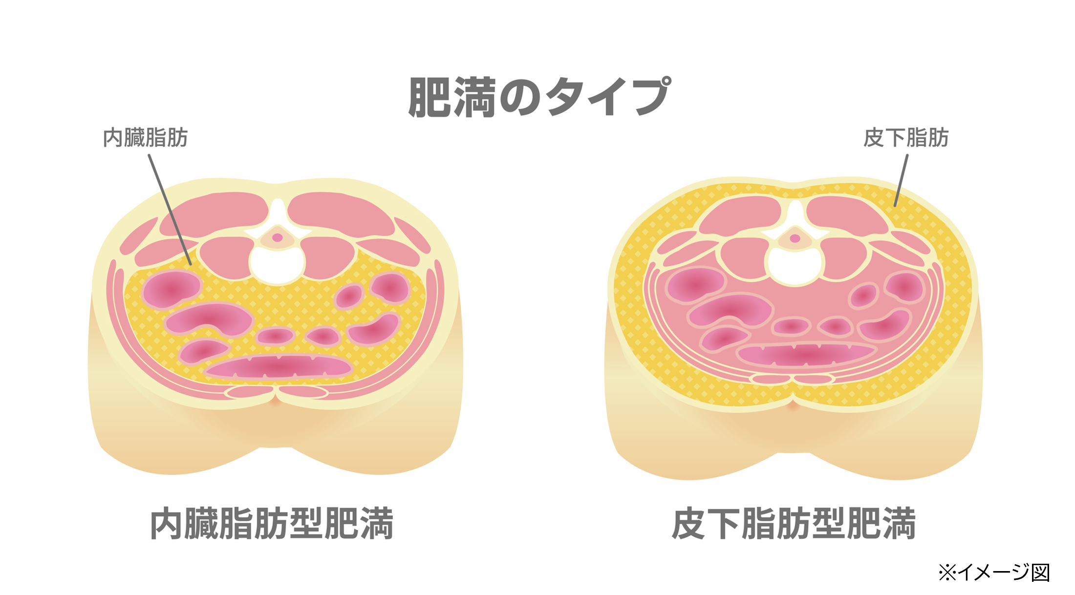内臓脂肪型肥満と皮下脂肪型肥満の腹部の輪切りのイメージ画像