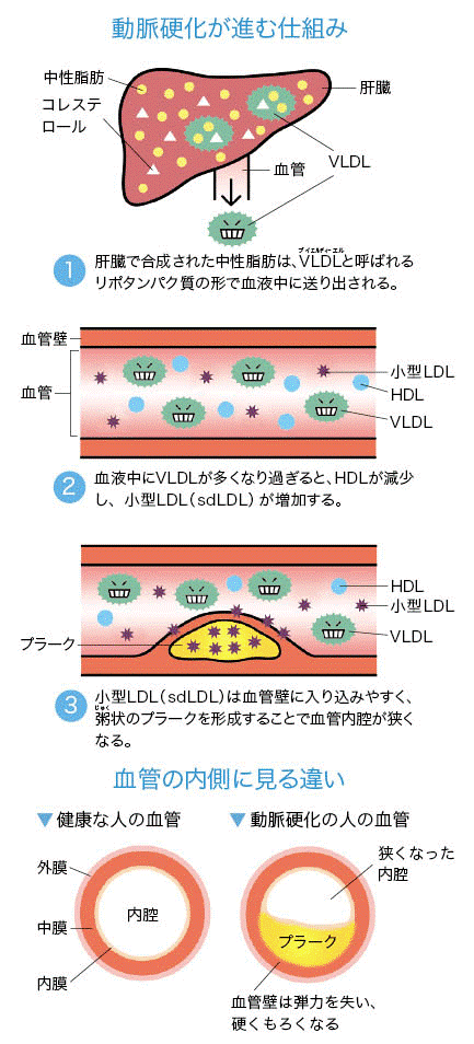 動脈硬化が進む仕組みと血管の内側の様子