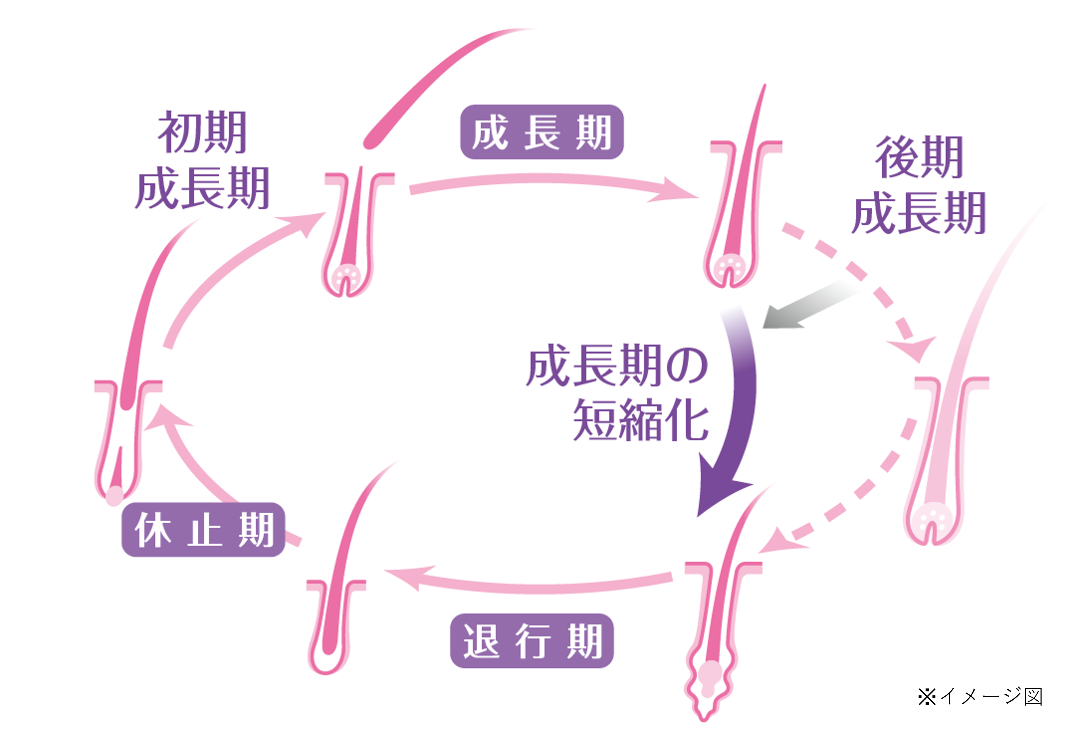 壮年性脱毛症のヘアサイクルの図