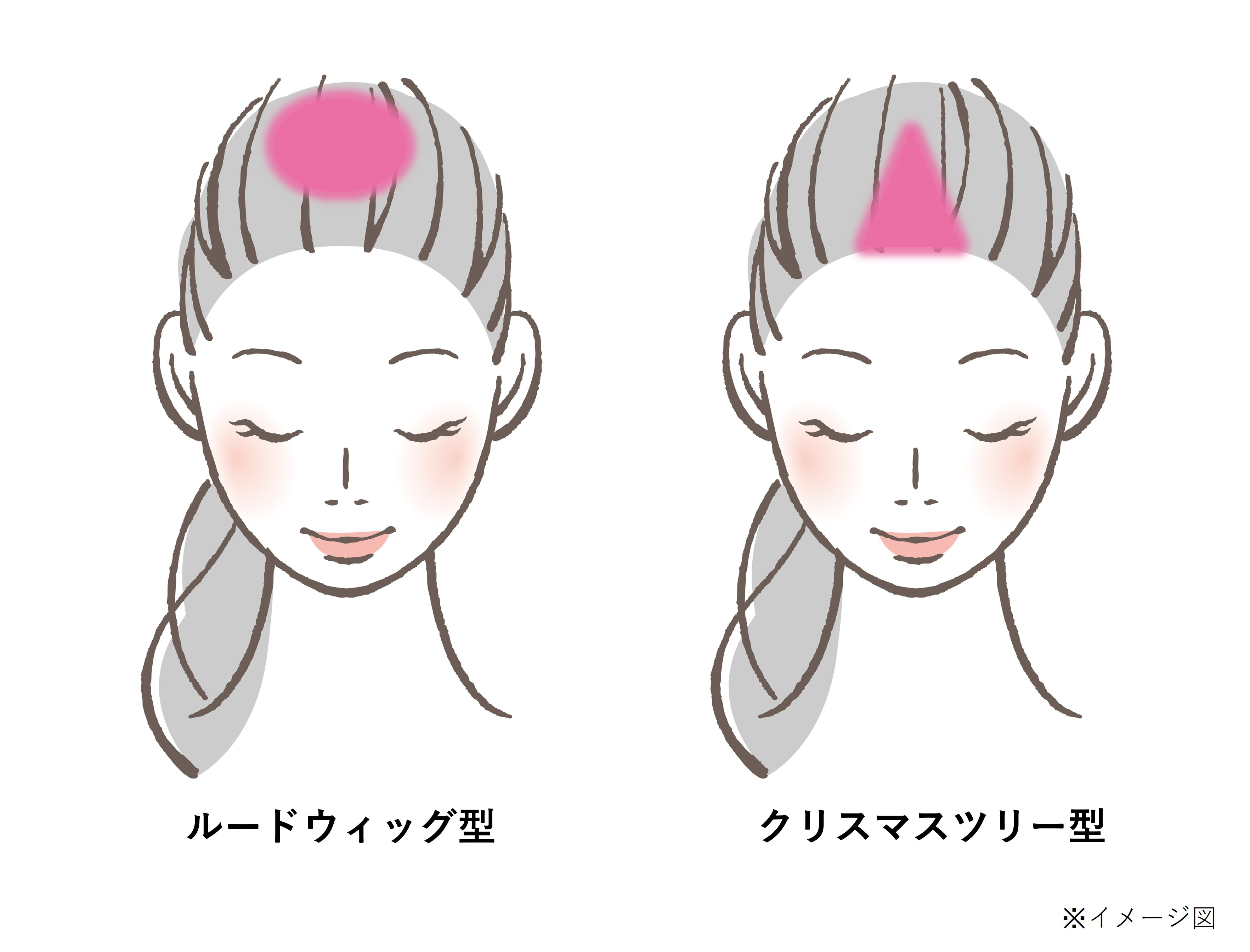 女性の壮年性脱毛症の進行パターン「ルードウィッグ型」「クリスマスツリー型」のイメージイラスト