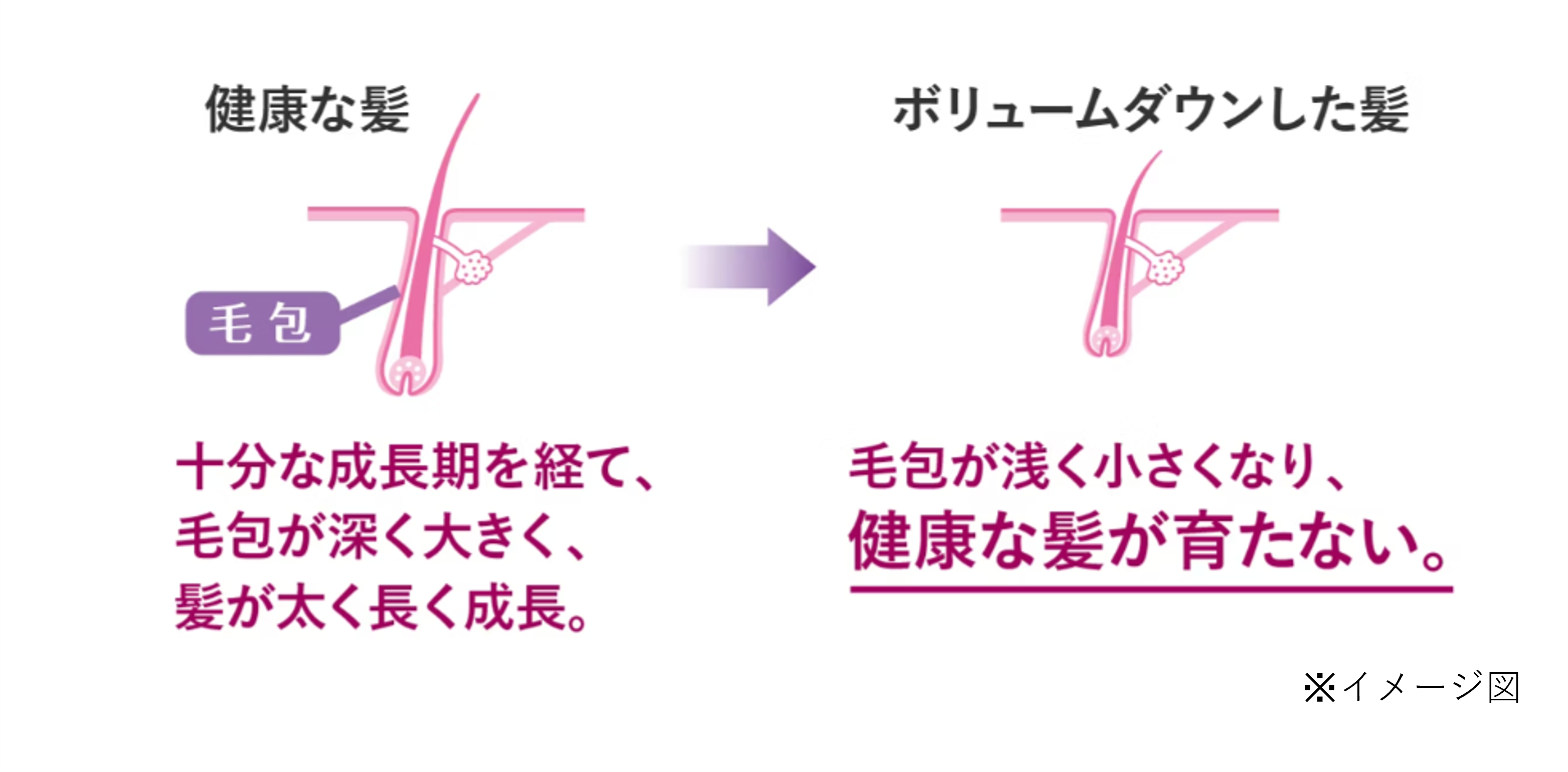 健康な髪は、十分な成長期を経て、毛包が深く大きく、髪が太く長く成長。一方、ボリュームダウンした髪は、毛包が浅く小さくなり、健康な髪が育たないことを示したイメージイラスト