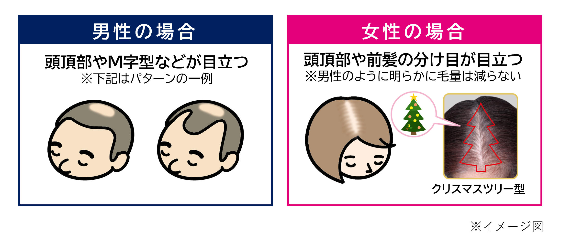 男性の壮年性脱毛症は頭頂部が薄くなる、左右のこめかみがM字型に薄くなるなどパターンが分かりやすいのに対し、女性は頭頂部の分け目のボリュームが減少したり、クリスマスツリーのような三角形に脱毛する進行パターンも見られるイメージイラスト
