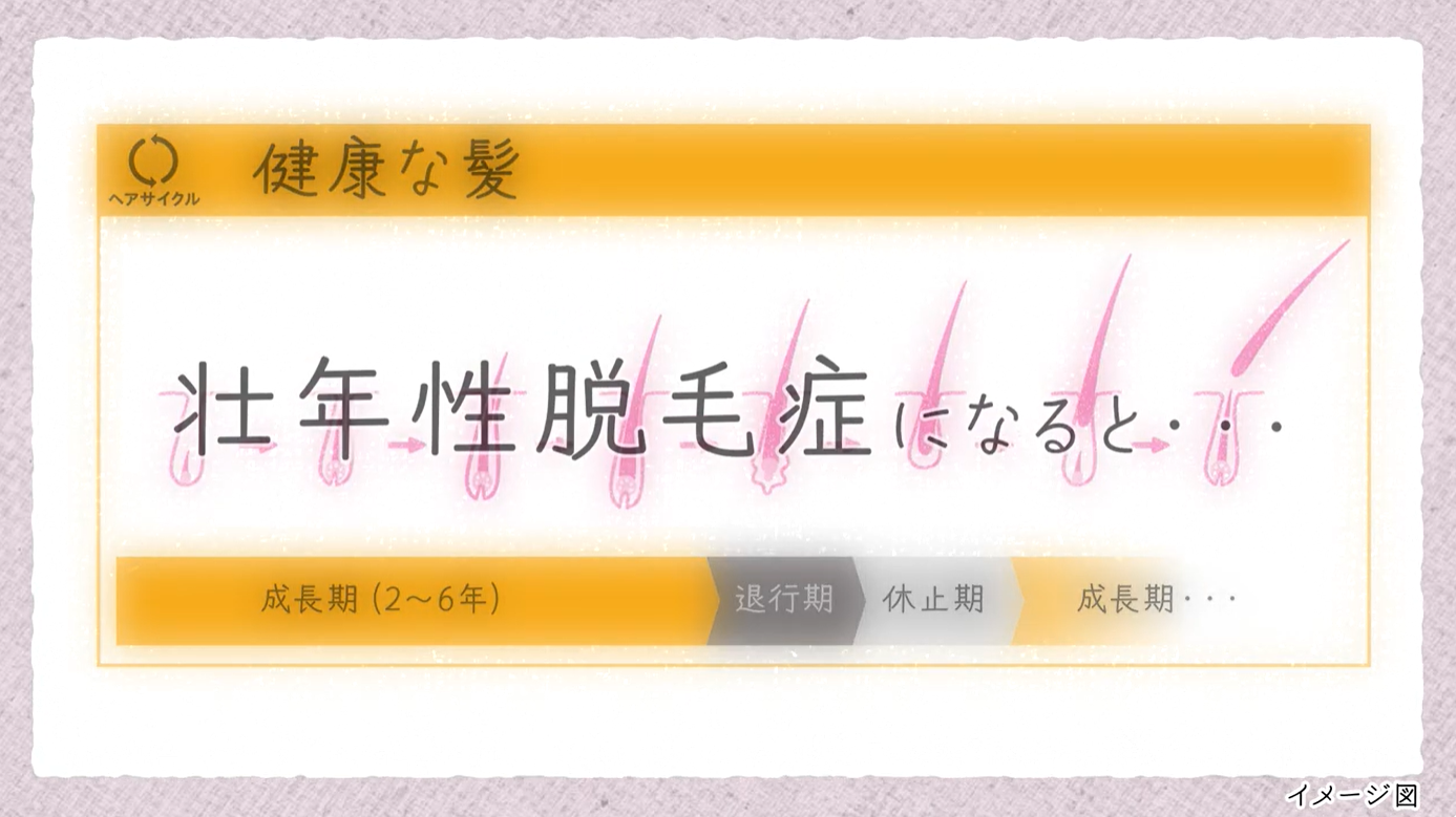健康な髪と壮年性脱毛症の髪のヘアサイクルの違いのイメージ画像