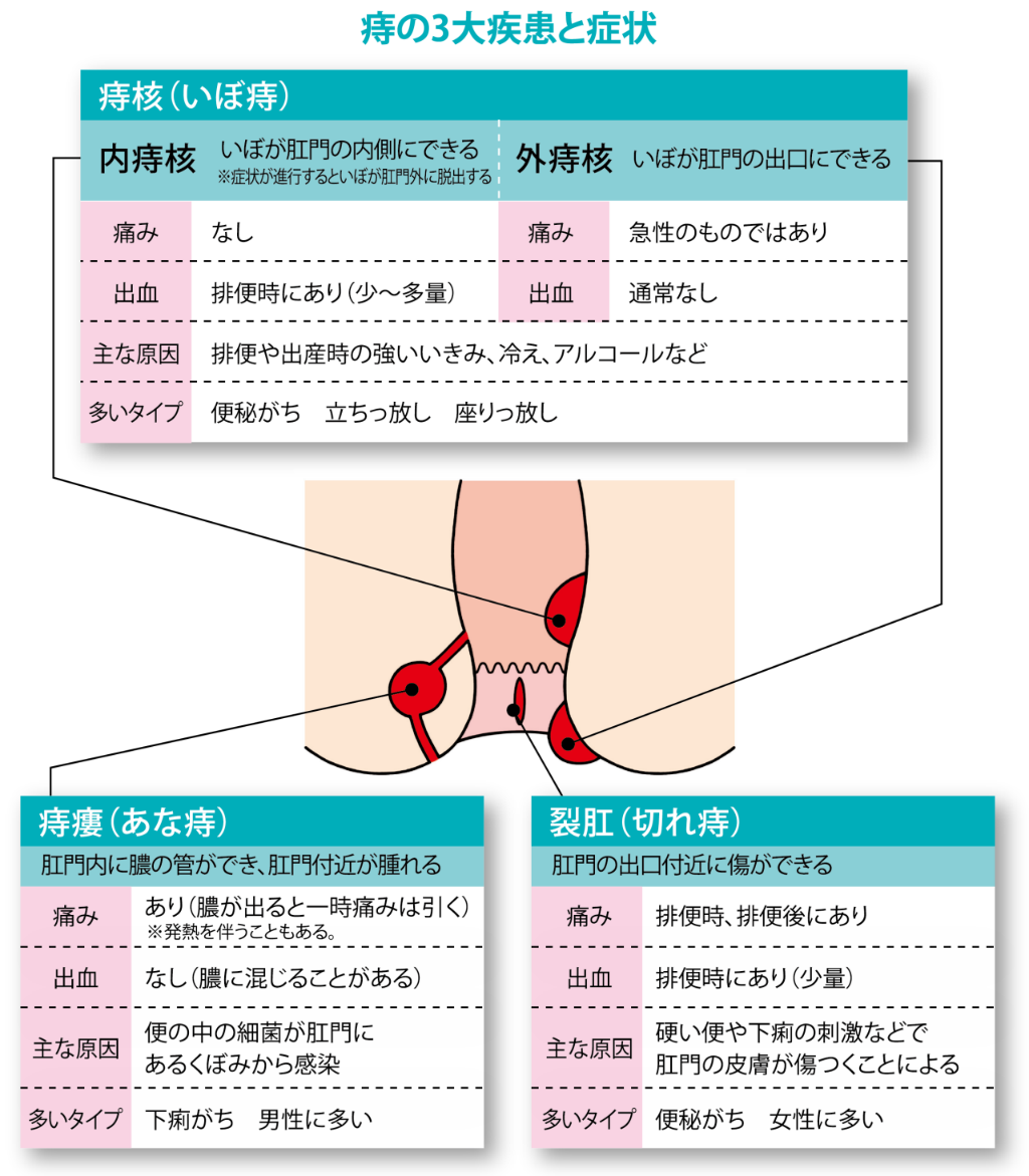 痔の3大疾患、痔核（いぼ痔）、痔瘻（あな痔）、裂肛（切れ痔）の症状のイラスト