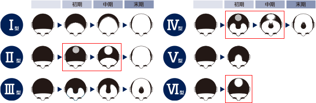 男性の壮年性脱毛症分類と進行パターン（緒方知三郎の分類）