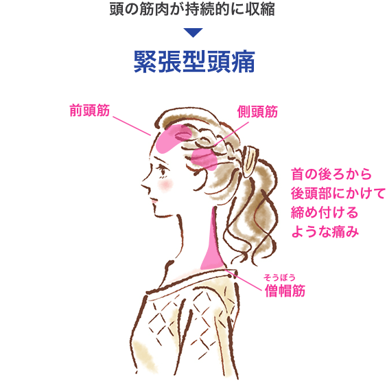 緊張型 慢性頭痛改善システム - その他