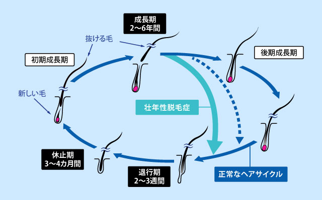 注意すべき抜け毛とは