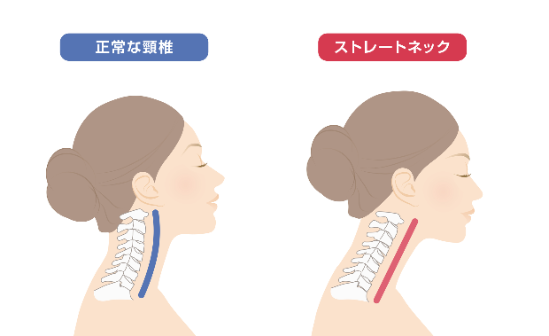 正常な頸椎　ストレートネックの頸椎