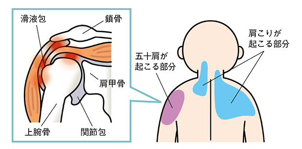 そもそも「五十肩」ってなに？