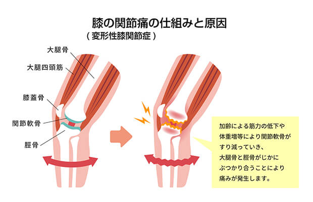 早めのメンテナンスで変形性膝関節症を防ごう！