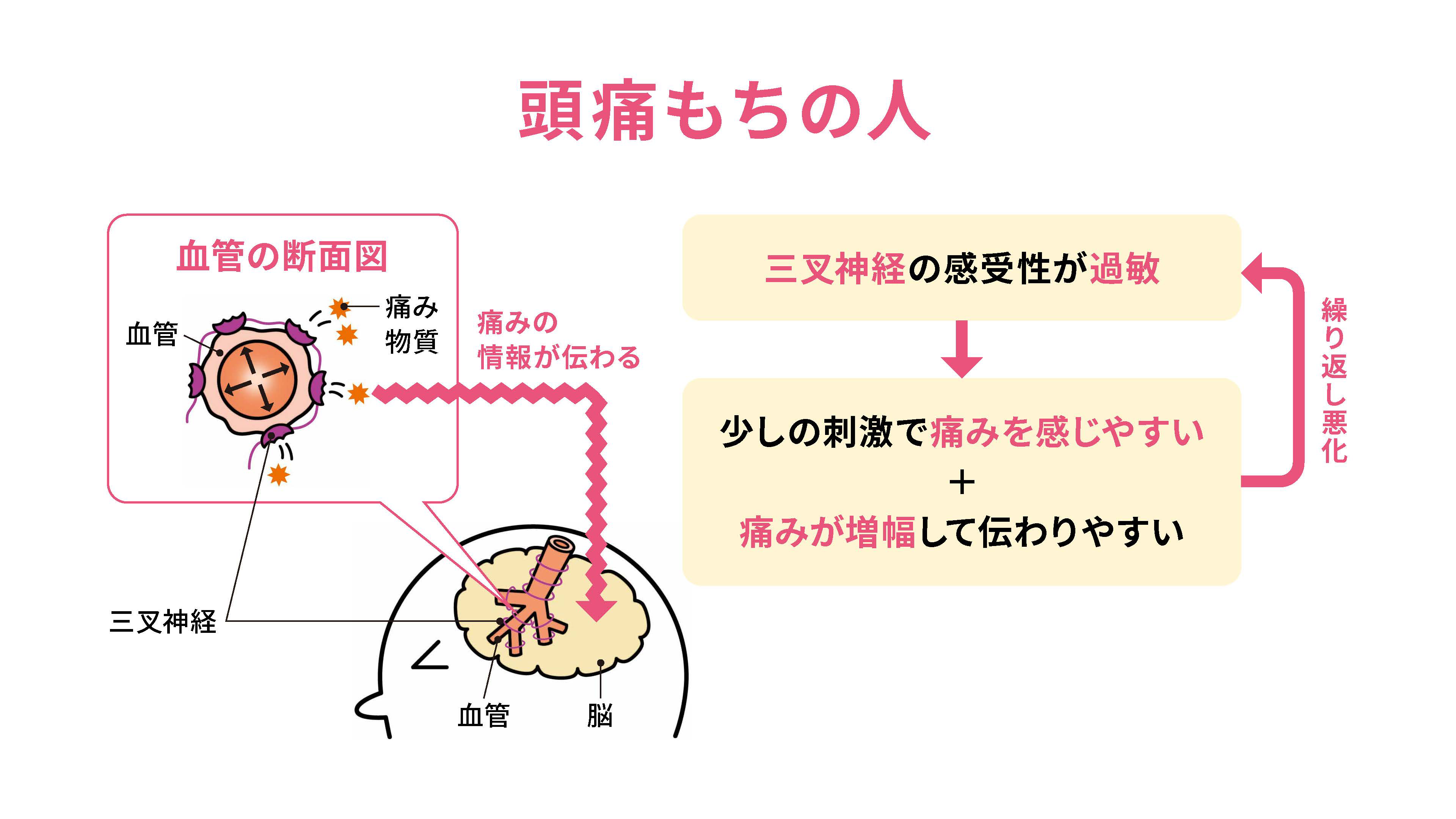 頭痛もちの人の片頭痛のメカニズム