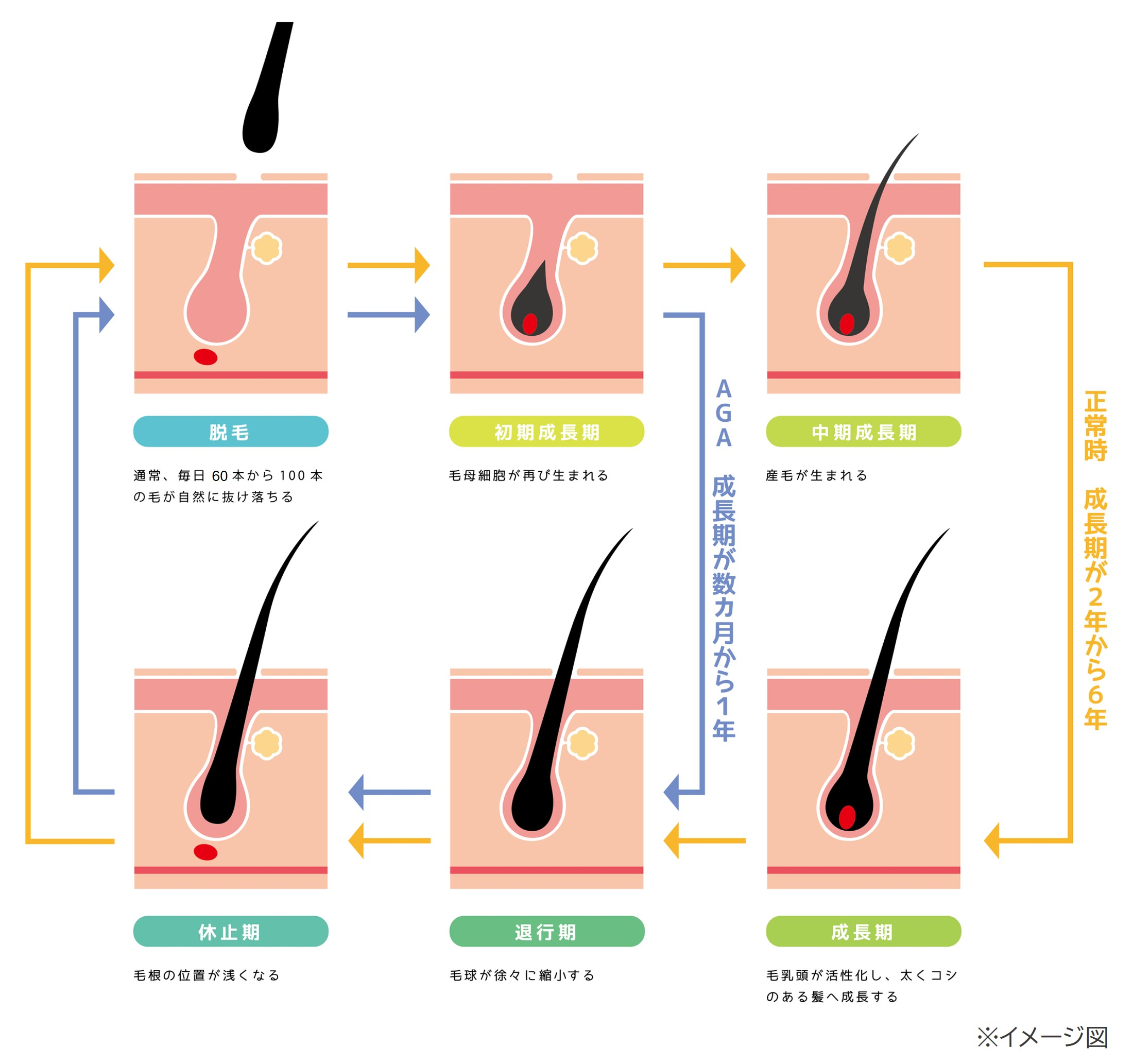 毛髪には成長し始めてから自然に抜け落ちるまでのヘアサイクルがあり、髪が伸びる「成長期」、成長が止まる「退行期」、脱毛の準備が進む「休止期」の３段階を経て、通常は２～６年で新しい毛に生え変わる。ところが、男性型脱毛症（AGA）になると、成長期がどんどん短くなり、毛髪は太い毛に成長しないまま退行期、休止期に移行し、通常より早いサイクルで毛が抜け落ちる。