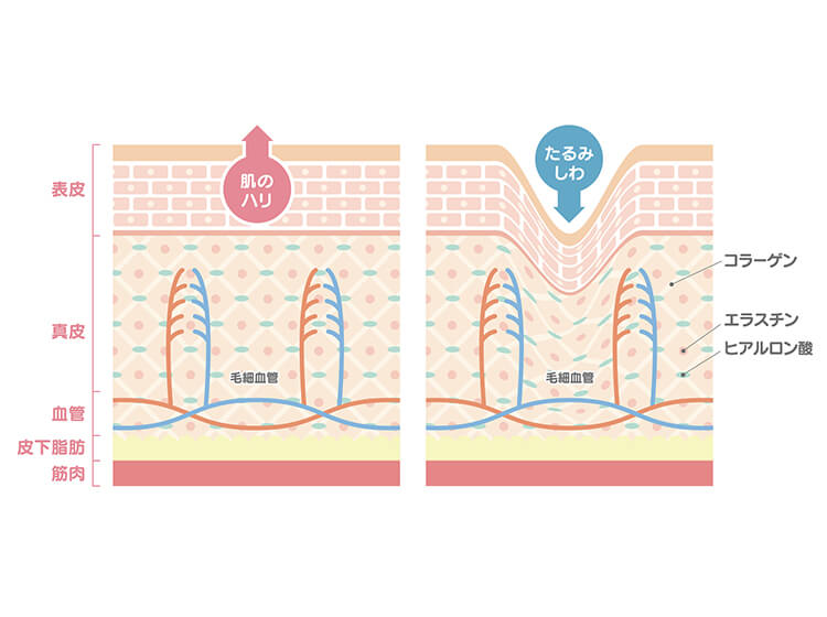更年期や加齢した肌にプラセンタがイチオシの理由④ シワのもとにアプローチ