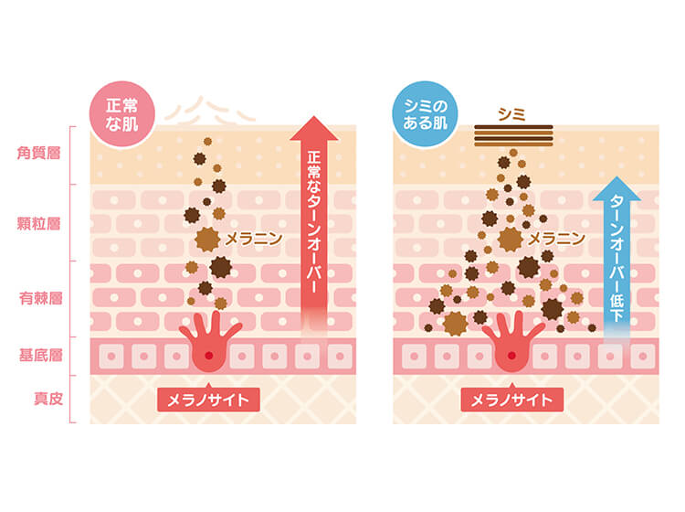 ③メラニン色素が蓄積し、シミとなる