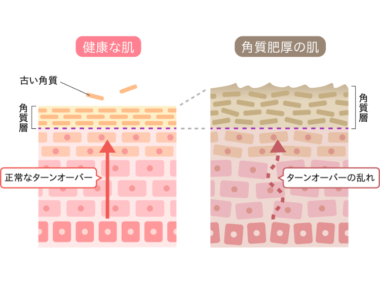若い頃と同じスキンケアではダメな理由① 老化でターンオーバーのサイクルが乱れるから