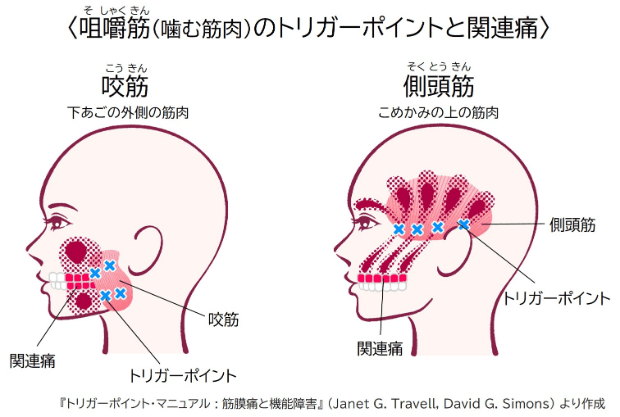 咀嚼筋（噛む筋肉）のトリガーポイントと関連痛