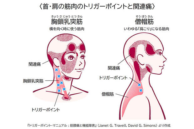 首・肩の筋肉のトリガーポイントと関連痛