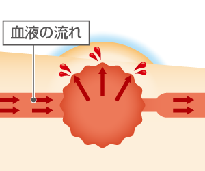 いぼ痔の出血を抑えているイメージ画像