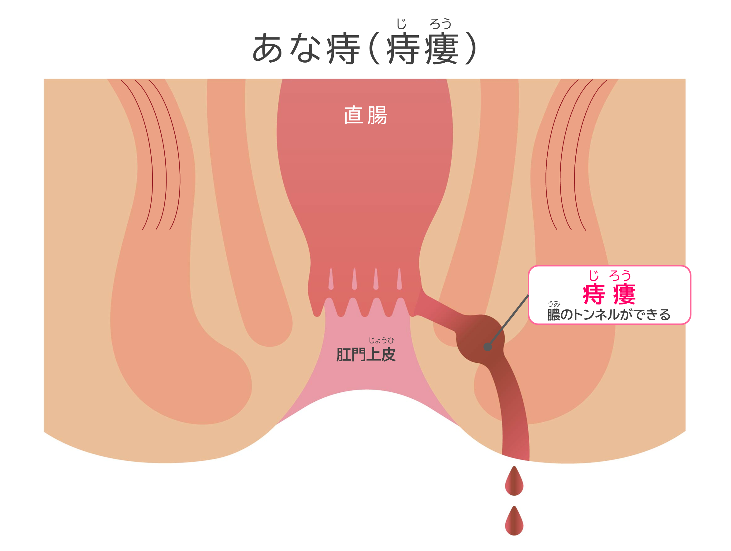 あな痔（痔瘻）のイメージイラスト