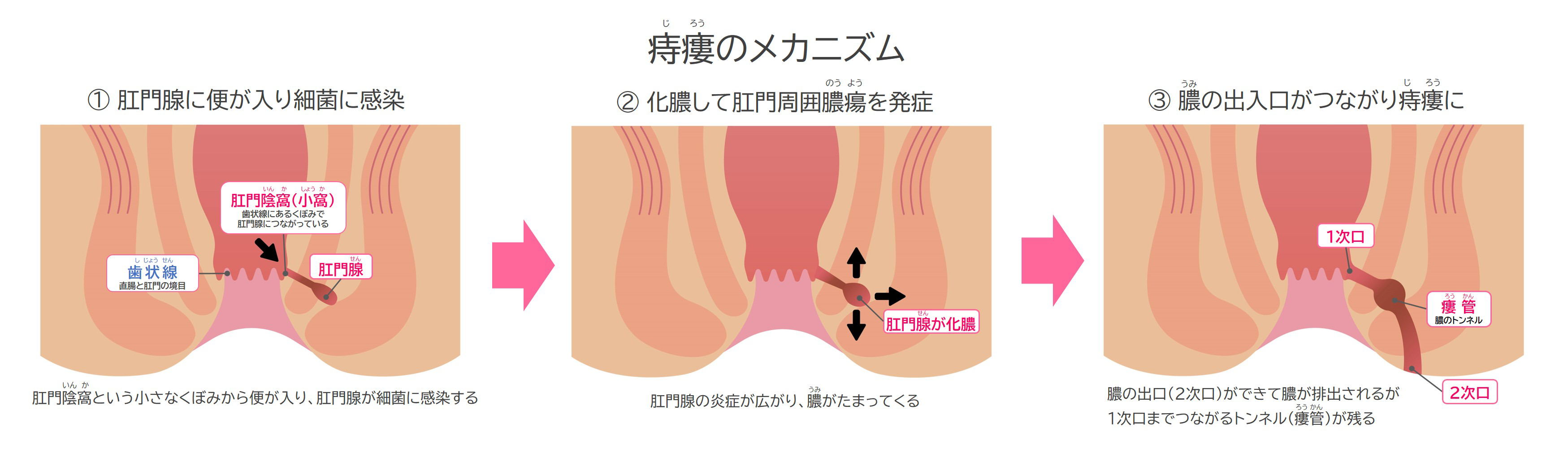 痔瘻（じろう）のメカニズム