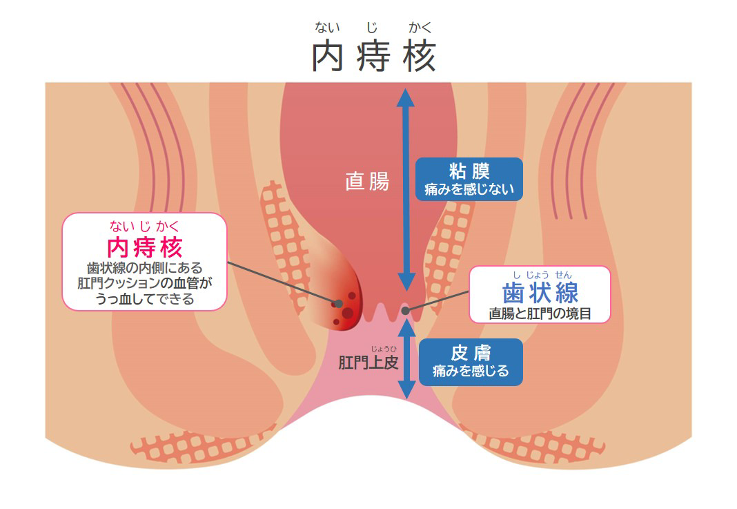 主な痔の種類とその症状を解説｜大正製薬の痔疾薬、止まって留まる ...