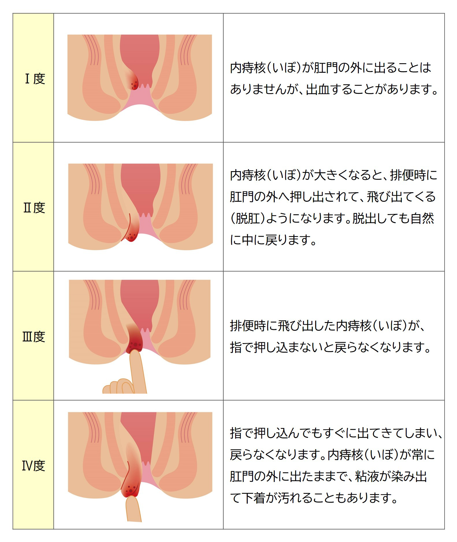 内痔核の症状