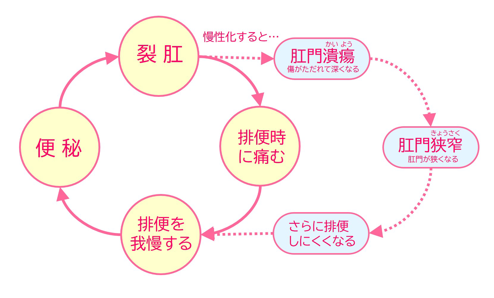 裂肛の痛みを避けるために排便を我慢すると便秘になる、そうすると裂肛になる…という悪循環は、「肛門ポリープ」「見張りいぼ」「肛門狭窄（きょうさく）」などを引き起こすことがあります。