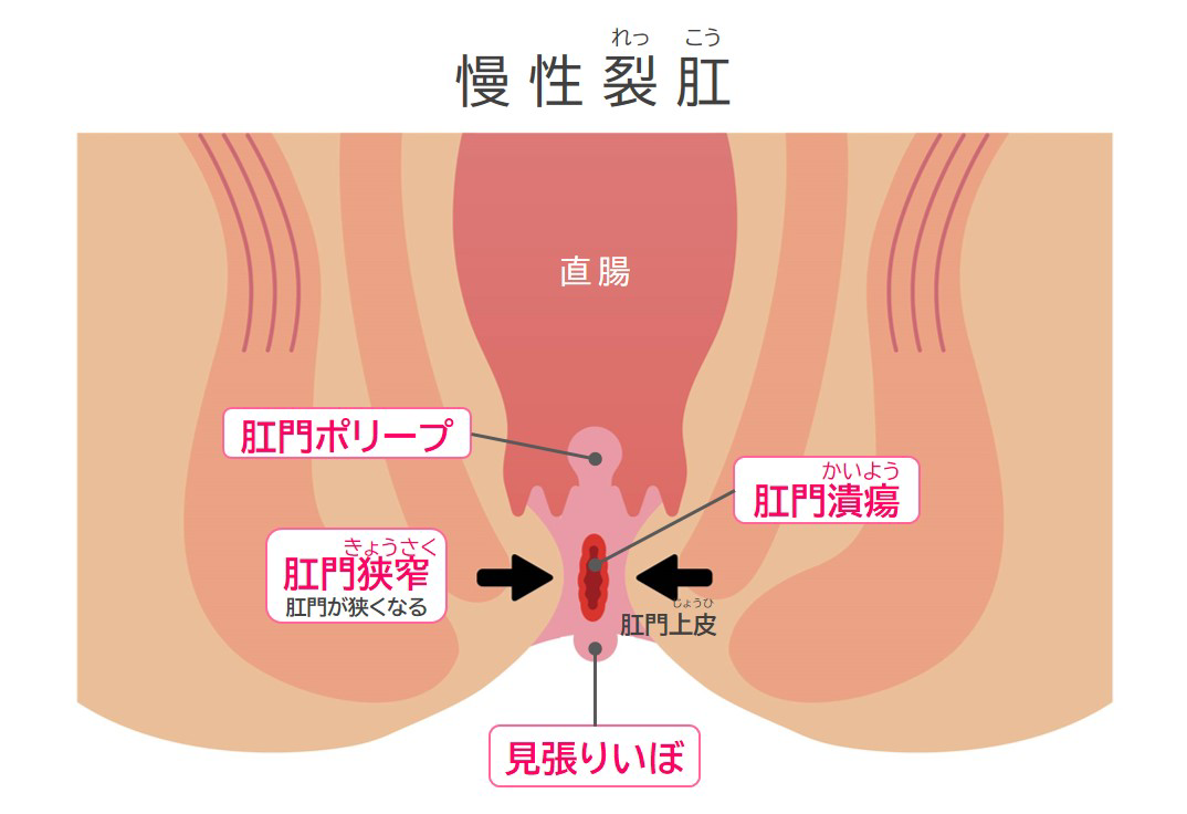 慢性裂肛になると「肛門ポリープ」「肛門潰瘍（かいよう）」「見張りいぼ」「肛門狭窄（きょうさく）」といった症状も現れます