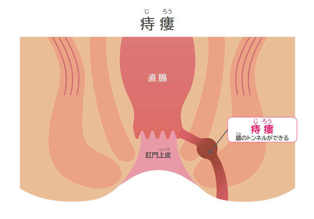 ①	痔瘻（じろう）