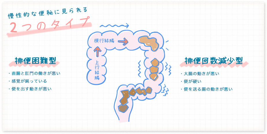 慢性的に便秘に見られる2つのタイプ「排便困難型」、「排便回数減少型」のイメージイラスト