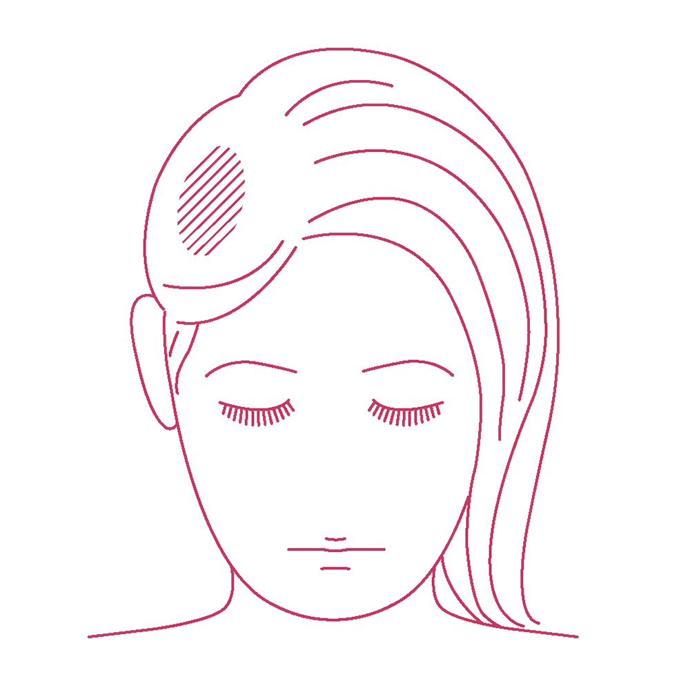 女性の薄毛の大敵である「円形脱毛症」