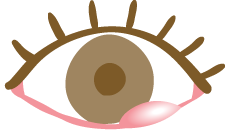 ものもらいの目のイメージ図