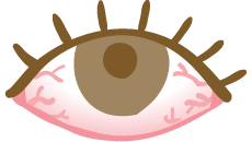 結膜炎（はやり目）のイメージ図