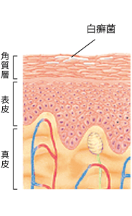 白癬菌が角質層に侵入、繁殖する。ケラチンを溶解し、その代謝物が皮膚の奥へ浸透。