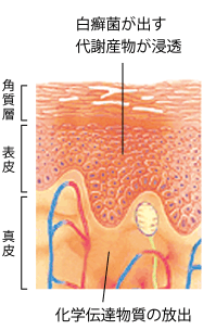 浸透した代謝産物を異物として認識し、化学伝達物質が出てくる。