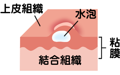 ヘルペス性口内炎