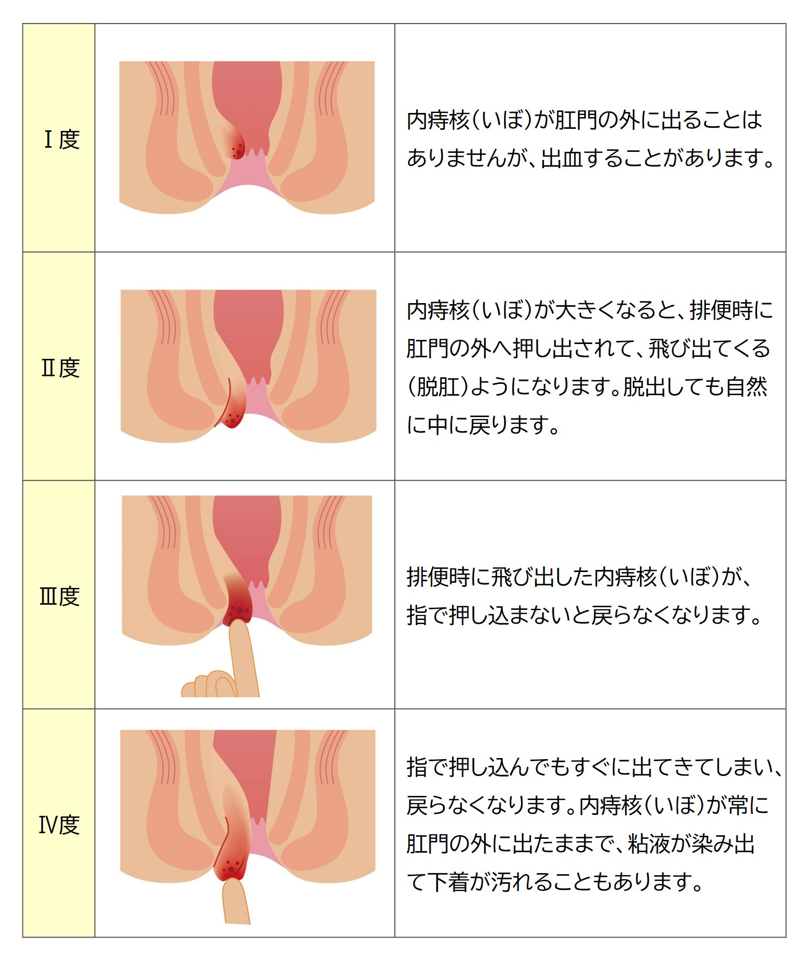 内痔核の症状は進行の度合いによって、Ⅰ度～Ⅳ度に分かれています。