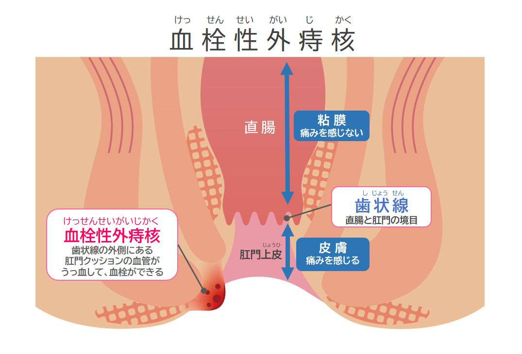 いぼ痔（内痔核・外痔核）の治し方は？ 手術は必要？｜大正製薬の痔疾 ...