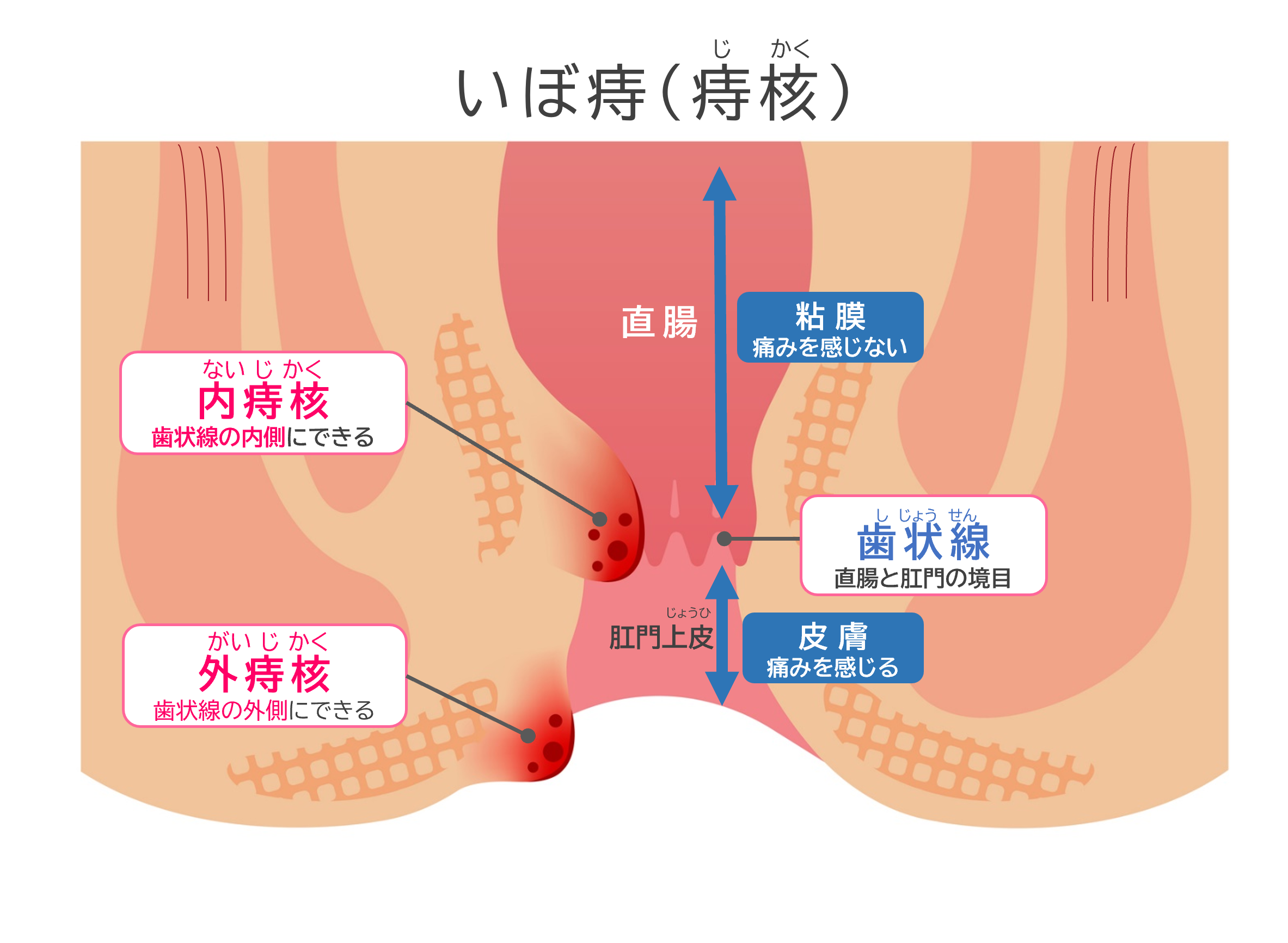 いぼ痔（痔核）のイメージイラスト