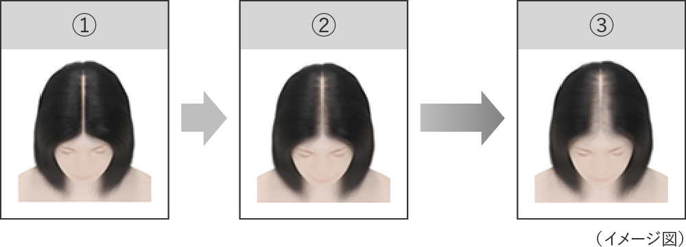 壮年性脱毛症の進行度合いの頭頂部のイメージ図