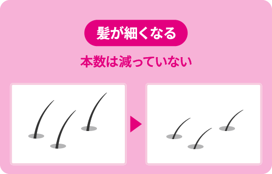 壮年性脱毛症の症状を表すイメージイラスト。髪が細くなる（本数は減っていない）