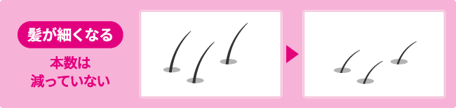壮年性脱毛症の症状を表すイメージイラスト。髪が細くなる（本数は減っていない）