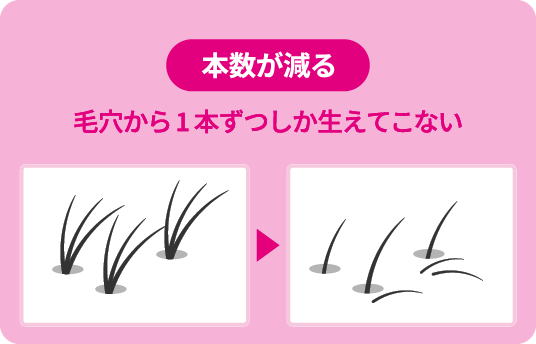 壮年性脱毛症の症状を表すイメージイラスト。本数が減る（毛穴から１本ずつしか生えてこない）
