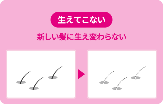 壮年性脱毛症の症状を表すイメージイラスト。生えてこない（新しい髪に生え変わらない）