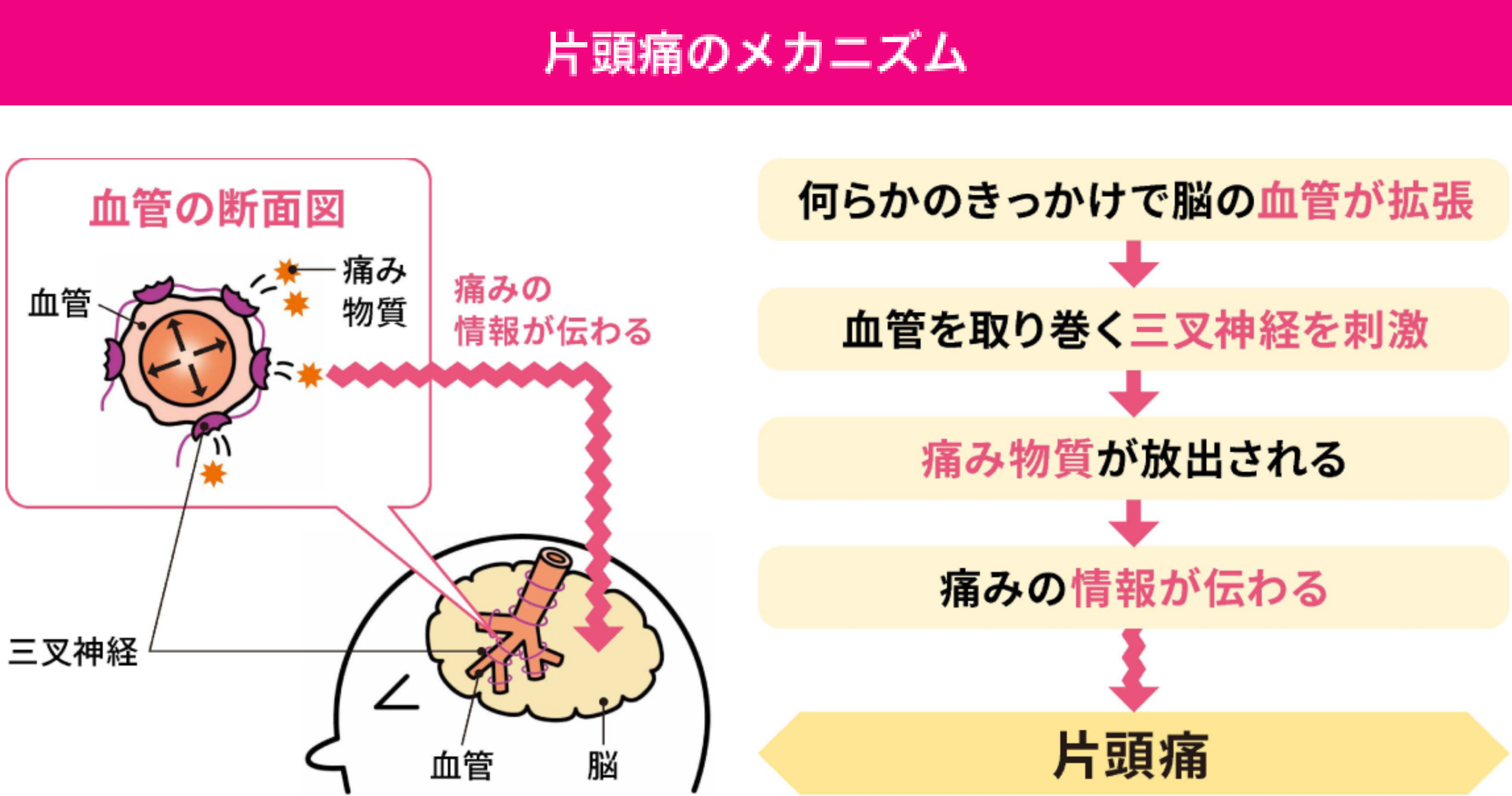 片頭痛が起きるメカニズム