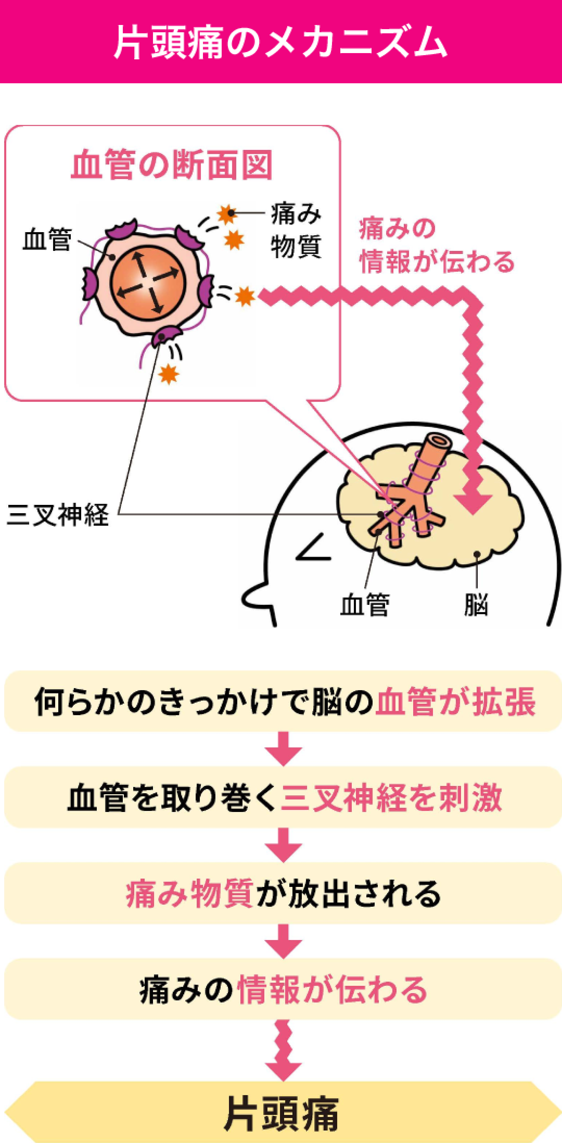 片頭痛が起きるメカニズム