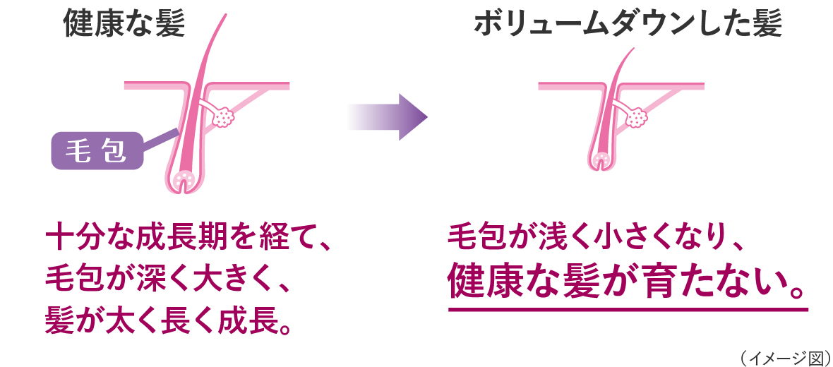 健康な髪は、十分な成長期を経て、毛包が深く大きく、髪が太く長く成長するが、ボリュームダウンした髪や壮年性脱毛症の髪では、毛包が浅く小さくなり、健康な髪が育たないイメージイラスト