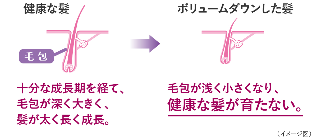 健康な髪とボリュームダウンした髪のイメージ図、健康な髪は十分な成長期を経て、毛包が深く大きく、髪が太く長く成長する。ボリュームダウンした髪は毛包が浅く小さくなり健康な髪が育たない