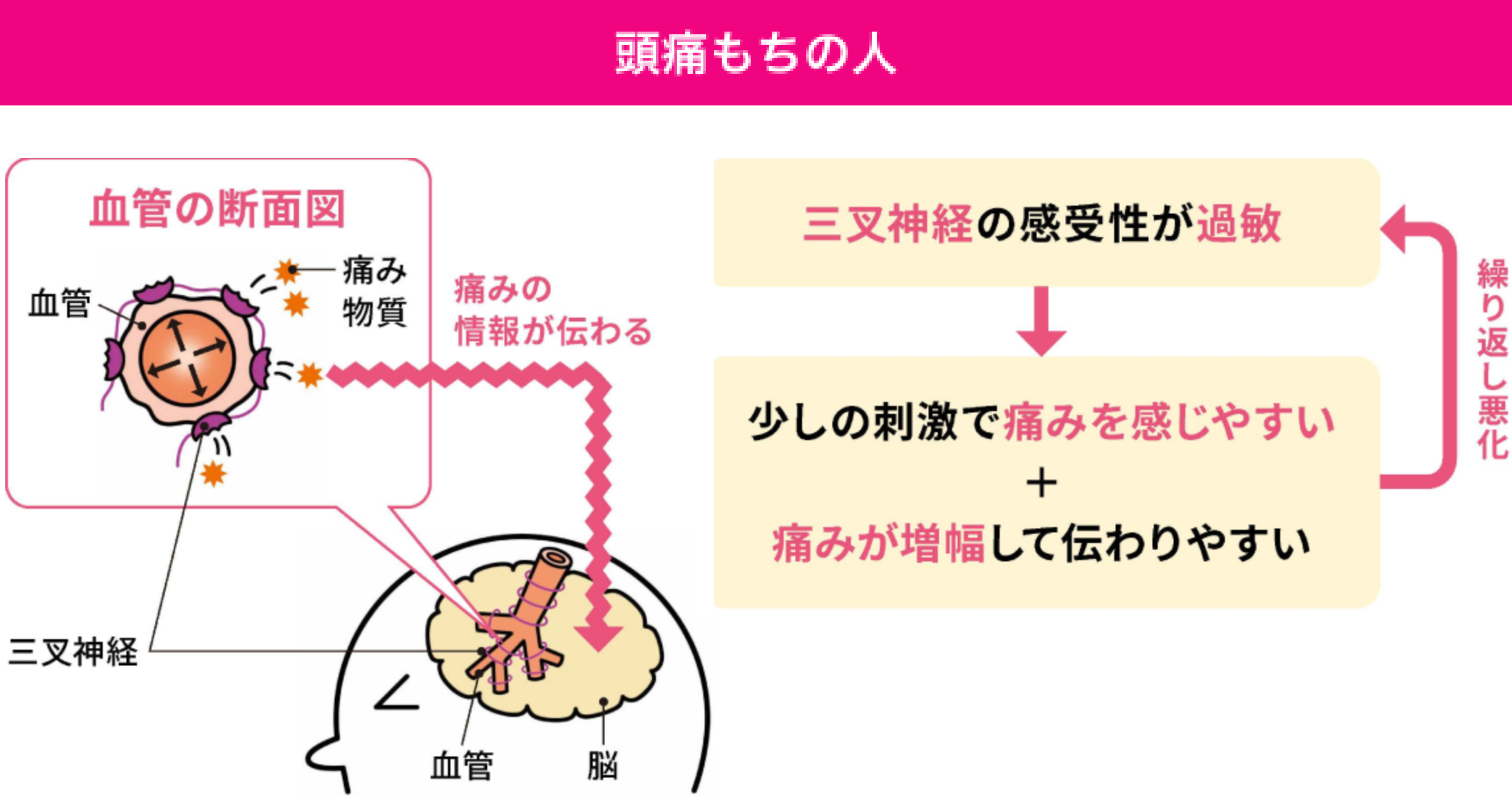 頭痛もちの人の片頭痛のメカニズム