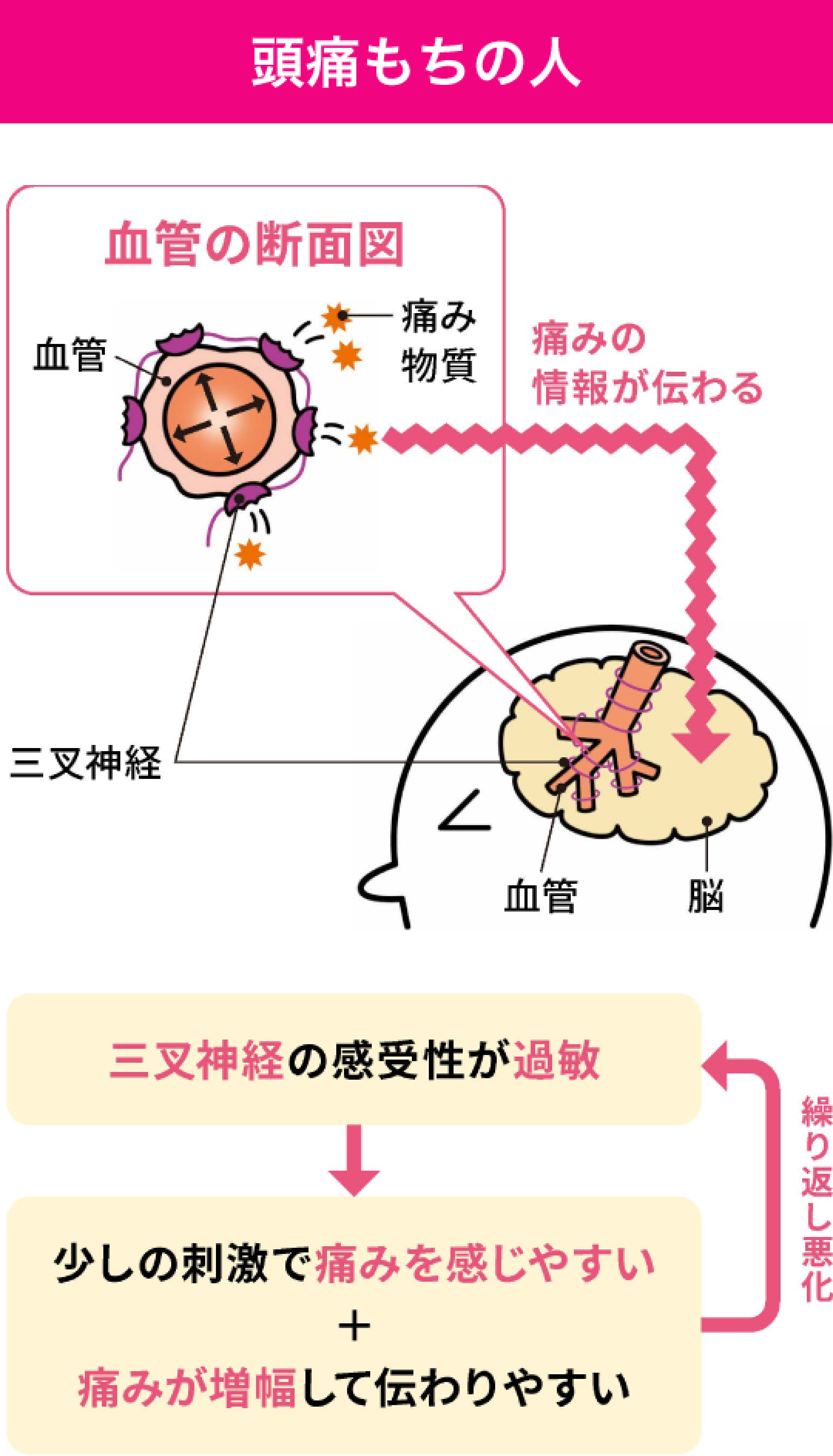 頭痛もちの人の片頭痛のメカニズム